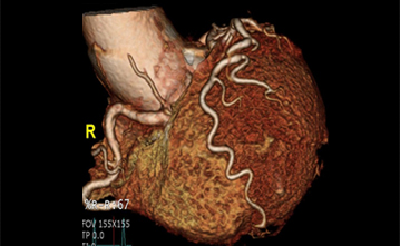 3D 심장혈관 조영 CT 사진