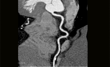 3D 심장혈관 조영 CT 사진