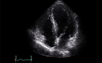 경흉부 심장 초음파 사진