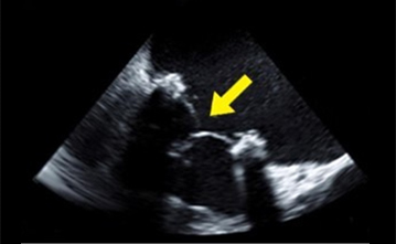 경식도 심장초음파 사진