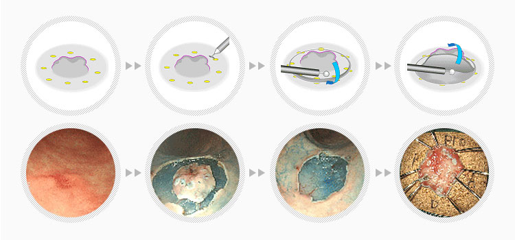 내시경 점막하박리술을 이용한 조기위암의 치료 진행 모습