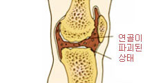퇴행성 관절염 사진(연골이 파괴된 상태)