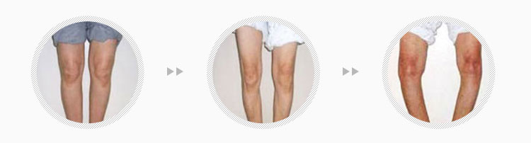 퇴행성 관절염 진행단계