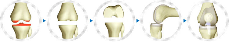 슬관절 치환술 사진