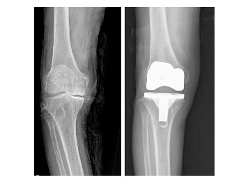 퇴행성관절염으로 인공관절치환술 사진