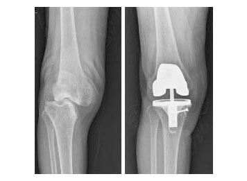 골결손을 동반한 관절염으로 인공관절치환술 사진 