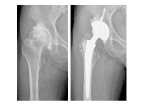 퇴행성 고관절염 사진