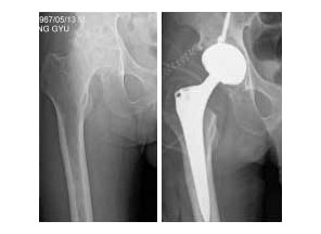 대퇴골두 무혈성괴사 사진
