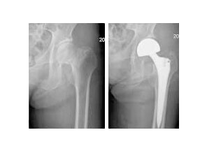 고관절부 골절 사진