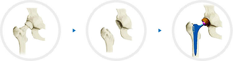 슬관절 치환술 사진