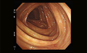 내시경 잘된 사항 사진