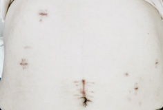 복강경 위암 수술 상처 사진