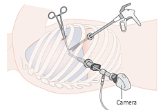 일반적인 3-port 흉강경 수술