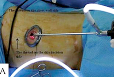 단일공(single-port) 흉강경 수술