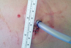 수술 후 단일공 흉강경 수술 상처 부위